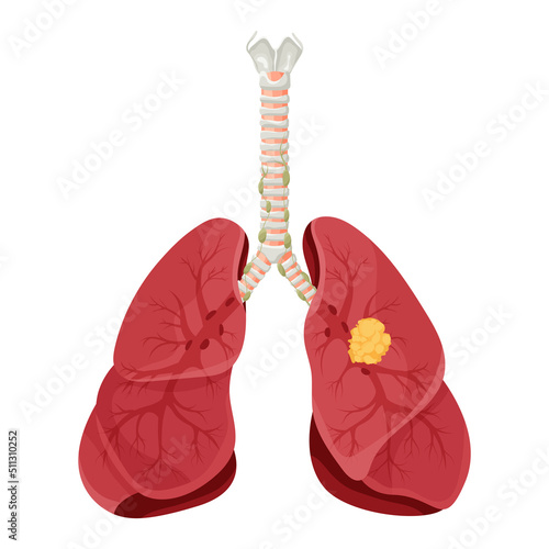 Diagram lung cancer disease. Concept disease human internal organs. Vector illustration, cartoon style.