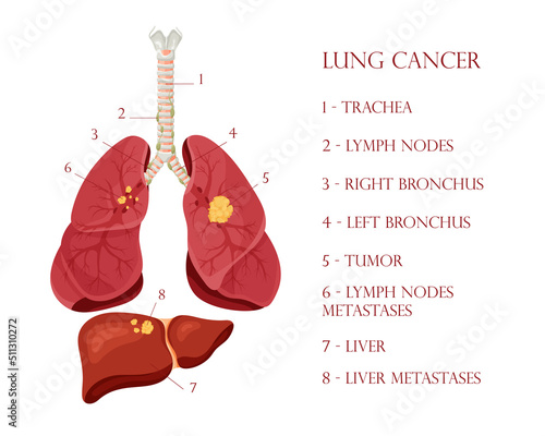 Diagram lung cancer disease. Concept disease human internal organs. Vector illustration, cartoon style.
