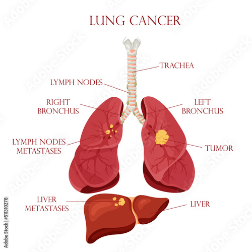 Diagram lung cancer disease. Concept disease human internal organs. Vector illustration, cartoon style.