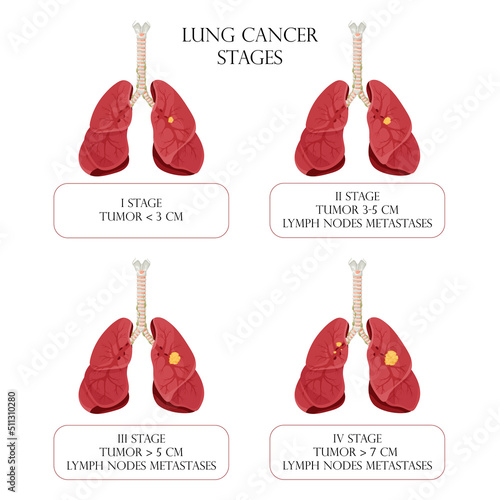 Lung cancer stages. Concept diseases human internal organs. Cartoon style, vector illustration.