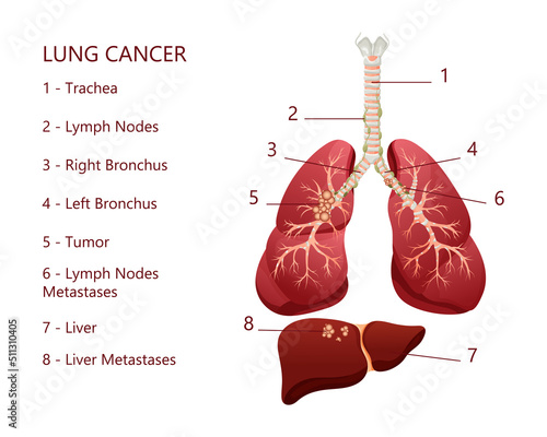 Diagram lung cancer disease. Concept disease human internal organs. Vector illustration, cartoon style.