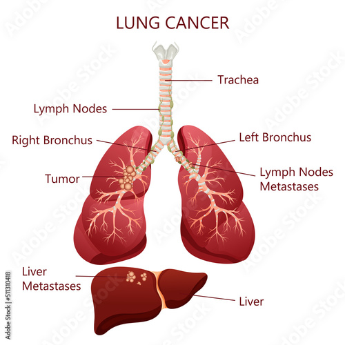 Diagram lung cancer disease. Concept disease human internal organs. Vector illustration, cartoon style.