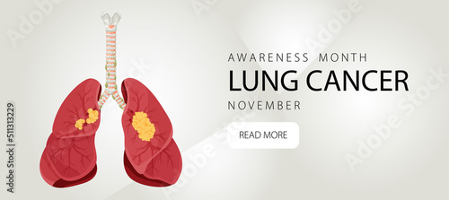 Banner informing about lung cancer. Design template for websites, magazines. Vector illustration cartoon style.