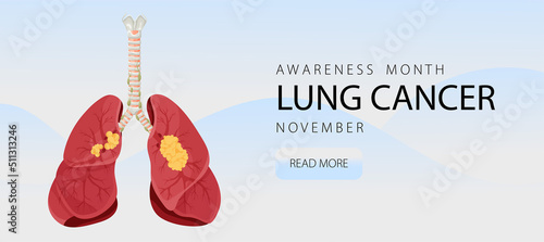 Banner informing about lung cancer. Design template for websites, magazines. Vector illustration cartoon style.