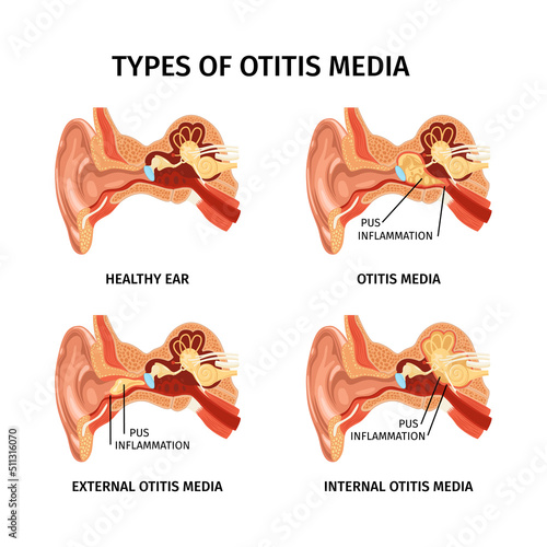 Realistic Ear Otitis Set