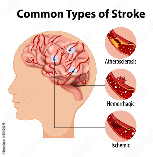 Human with common types of stroke