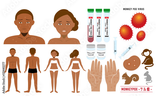 サル痘 ウイルス 検査 ワクチン 顔と全身の症例 アフリカ系