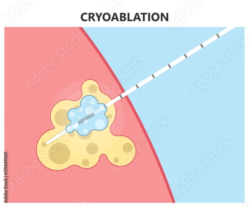 Cryoablation and cold therapy treat cancer