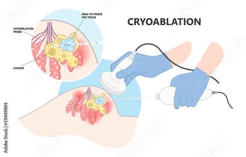 Cryoablation and cold therapy treat cancer