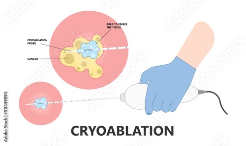 Cryoablation and cold therapy treat cancer