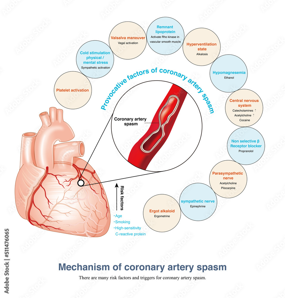 Smoking is the most dangerous factor for coronary artery spasm. Body ...