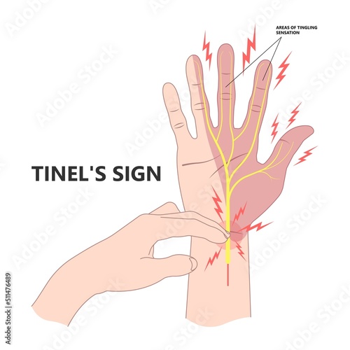 Tinel’s and phalen's sign test for carpal tunnel syndrome compressed hand with Guyon's canal exam palm arm thumb index middle ring little flexor tendon use tapping