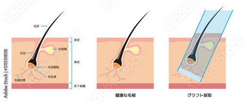 毛根の断面解剖図と薄毛・AGAの自毛植毛
