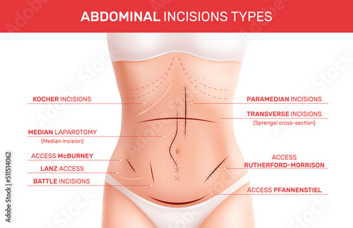 Abdominal Incision Types Infographics
