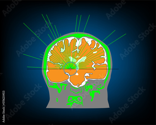 Illustration of magnetic resonance guided focused ultrasound (MRgFUS) at thalamus (VIM) for treatment of essential tremor.
