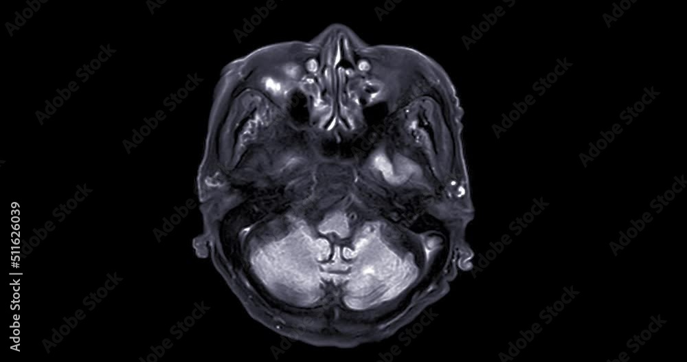 MRI of the brain or Magnetic resonance imaging of the brain for ...