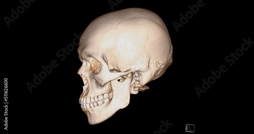 CT Scan of facial bone 3D rendering showng human skull 
 turnaround on the screen . photo