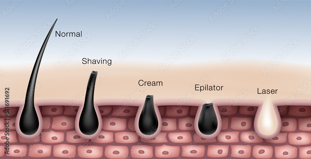 Hair removal comparison chart by shaving, waxing, depilatory creams,  epilator and laser hair removal. EPS Realistic file. Stock Vector | Adobe  Stock