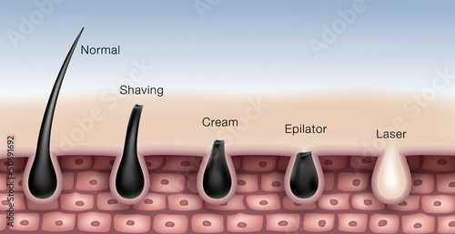 Hair removal comparison chart by shaving, waxing, depilatory creams, epilator and laser hair removal. EPS Realistic file.