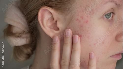 Woman with post acne scars. Skin health. 