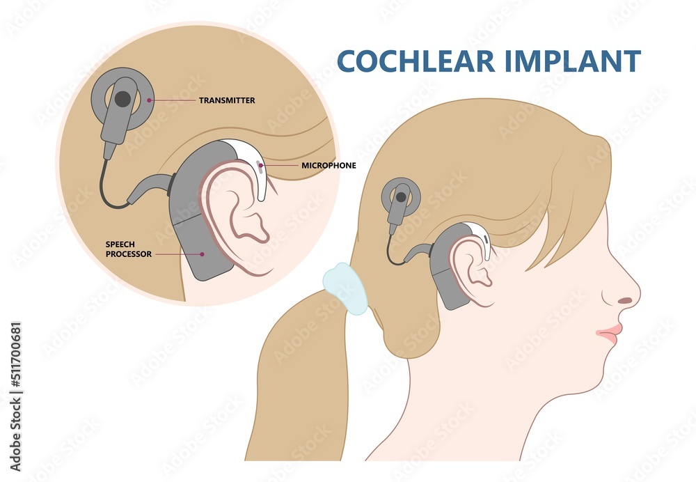 hearing aid ear child deaf signal baby inner middle bone loss outer canal birth meniere's cochlea brain implantation test exam hearing aid ear child deaf signal baby inner middle bone loss outer canal birth meniere's cochlea brain implantation test exam