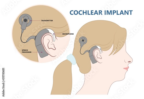 hearing aid ear child deaf signal baby inner middle bone loss outer canal birth meniere's cochlea brain implantation test exam