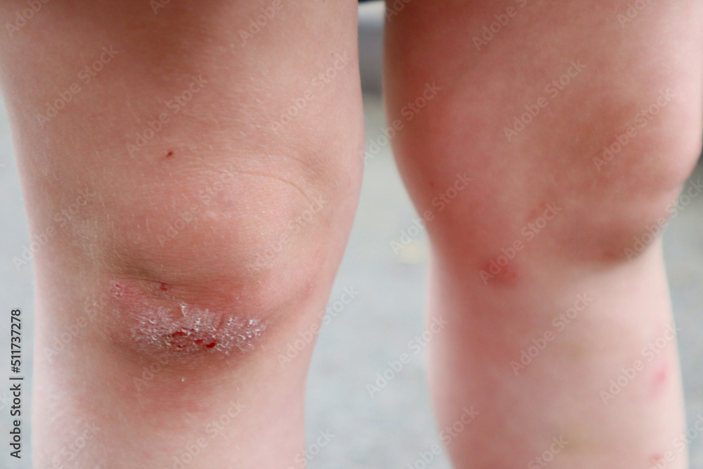 Fototapeta premium broken children's knees close-up. sadins