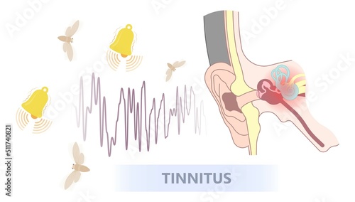 Tinnitus disorder a ringing sound in the ear hearing loss wave level anxiety test assist exam inner exposure problem circulatory nerves hair cell canal Earwax photo