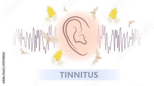 Tinnitus disorder a ringing sound in the ear hearing loss wave level anxiety test assist exam inner exposure problem circulatory nerves hair cell canal Earwax