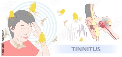 Tinnitus disorder a ringing sound in the ear hearing loss wave level anxiety test assist exam inner exposure problem circulatory nerves hair cell canal Earwax