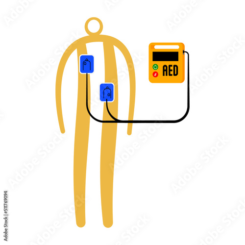 Illustration of apply an AED pads for adult.