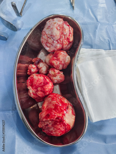 A picture of a fibroid (multiple myoma) surgically removed from the uterus of a patient  photo