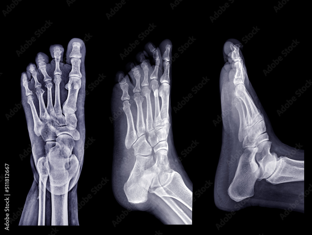 Collection of Foot x-ray image isolated on black background. Collection of Foot x-ray image isolated on black background.
