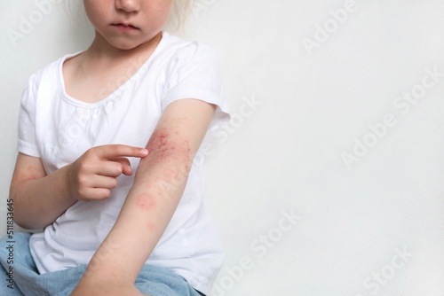 The child scratches atopic skin. The child applies a special cream to atopic skin. Dermatitis, diathesis, allergy on the child\'s body.