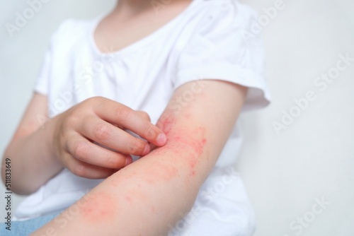 The child scratches atopic skin. The child applies a special cream to atopic skin. Dermatitis, diathesis, allergy on the child's body.	 photo