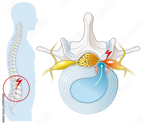 Herniated disc of the lumbar spine, stenosis, slipped disc, labeled illustration photo