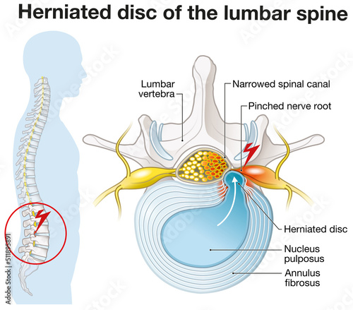 Herniated disc of the lumbar spine, stenosis, slipped disc, labeled illustration photo
