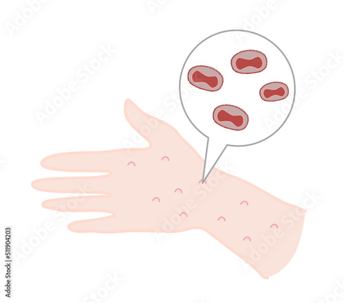 The rash on human hand are pathology symptom of smallpox or monkeypox disease that is occurred by Variola virus (Poxvirus) infection.