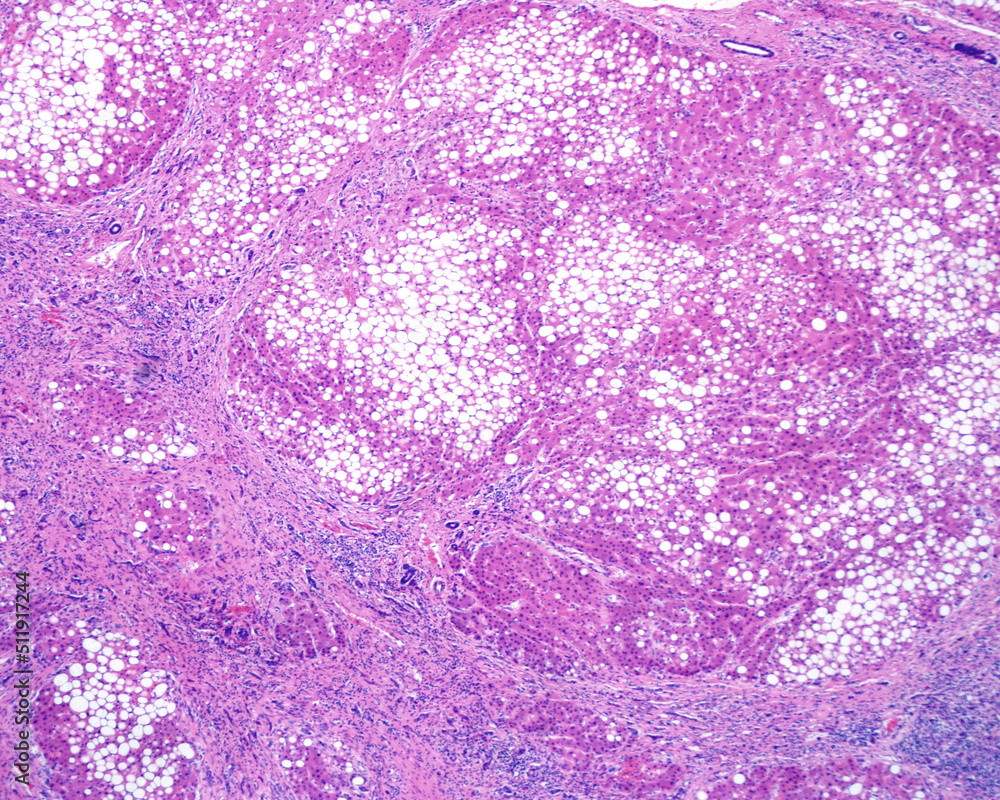Obraz premium Human liver. Cirrhosis and steatosis