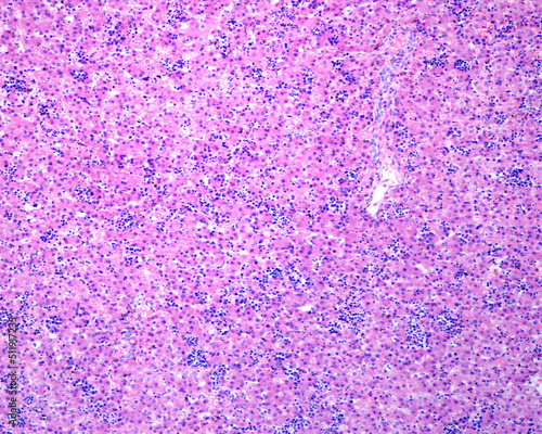 Liver. Erythroblastosis fetalis photo