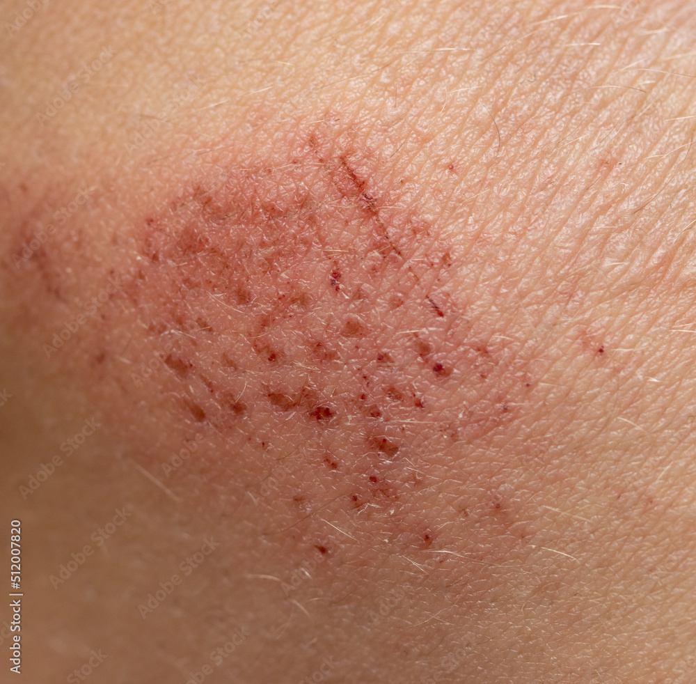 Fototapeta premium scratches on the skin as a background