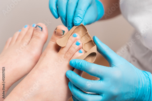 Podiatrist in blue gloves inserts a silicone impression to fix the ingrown toenail on the client's big toe. Close-up. The concept of podology and chiropody