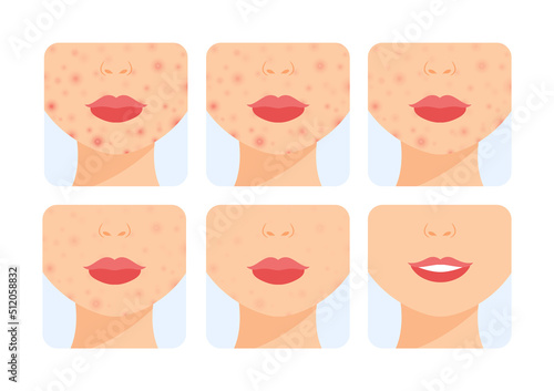 Acne on Chin and Cheeks. Female Part of Face in a Rash. Acne Treatment. Before After. Steps. Healthy Clean Skin and a Happy Smile. Color Cartoon style. White background. Vector image for Beauty design