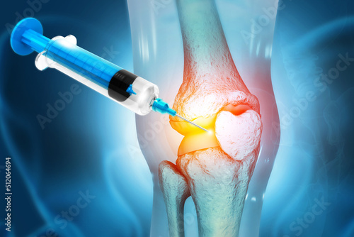 Tableau sur toile Anatomy Human Knee Joint Treatment, Osteoarthritis Injection, Drug Method Inject