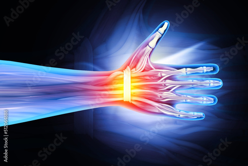 Wrist bones injury, wrist pain, 3d illustration photo