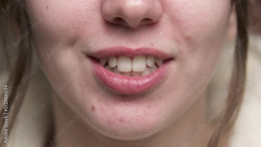 Close-up of a caucasian woman. Chin and mouth. The girl yawns. Correction of bite in young people with acne on the chin Close-up of a caucasian woman. Chin and mouth. The girl yawns. Correction of bite in young people with acne on the chin