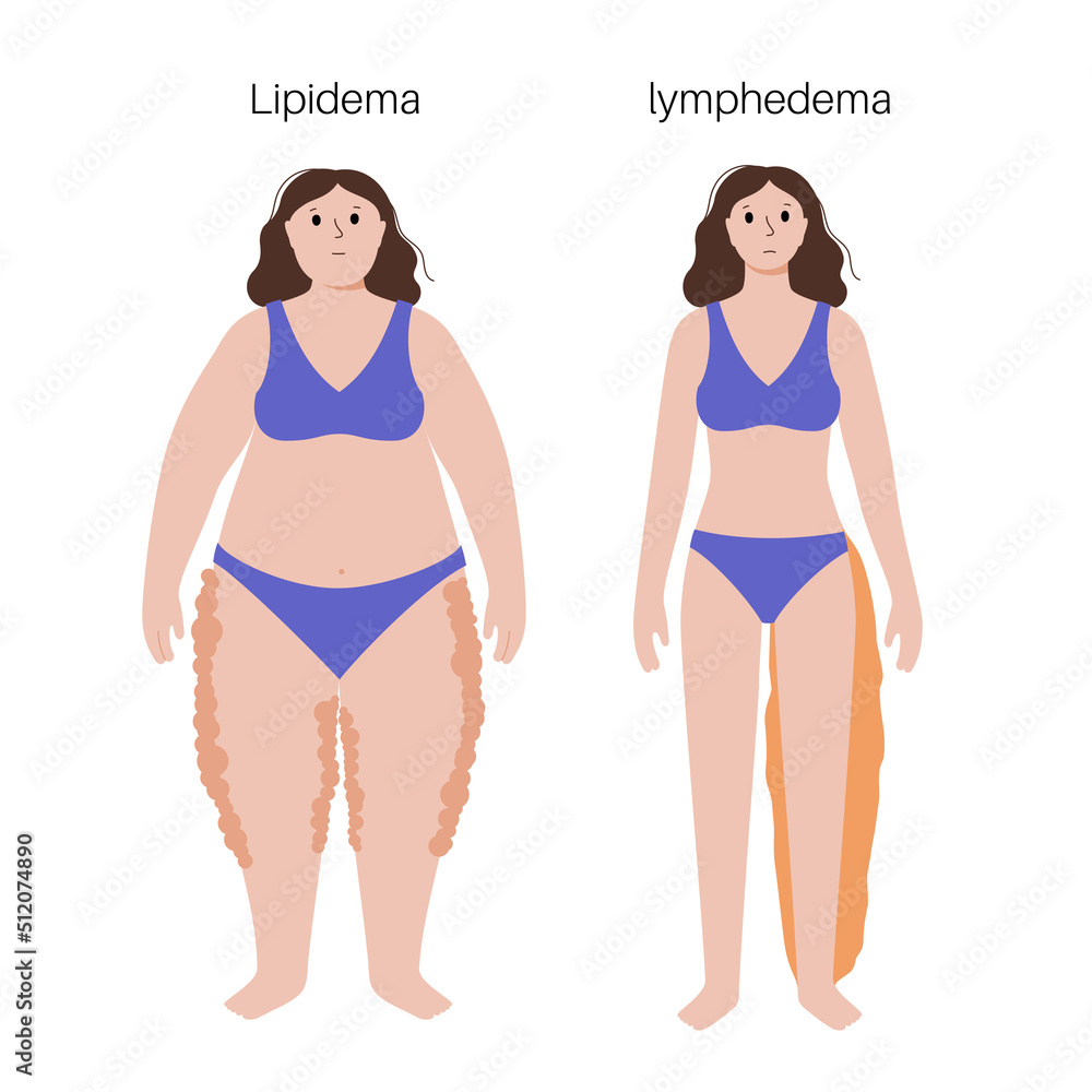 Lymphedema and lipedema Lymphedema and lipedema