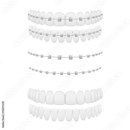 Braces on white teeth and after cure orthodontic dentistry medical treatment set realistic vector