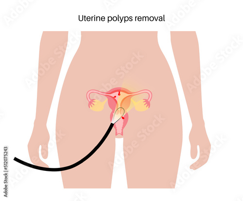 Uterus Polyps Disease