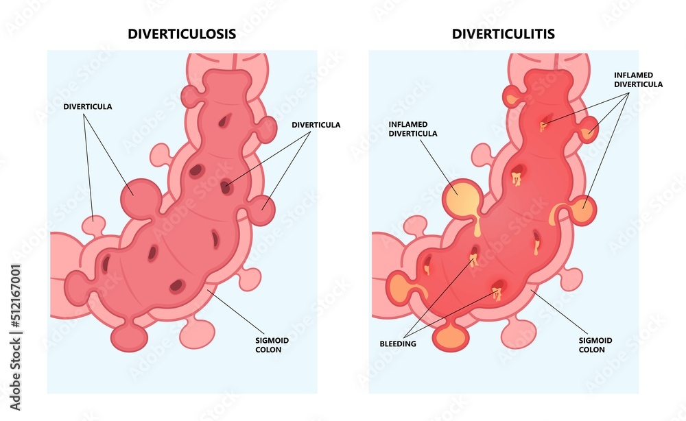 Bowel colon cancer and crohn's disease polyp hernia rectum diverticula